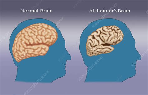 Is it normal for Alzheimers patients to moan, but not hurt ...